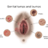 Red Bumps on Your Genitals?