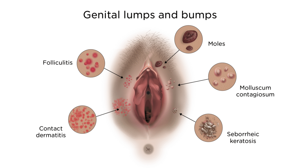 Red Bumps on Your Genitals?