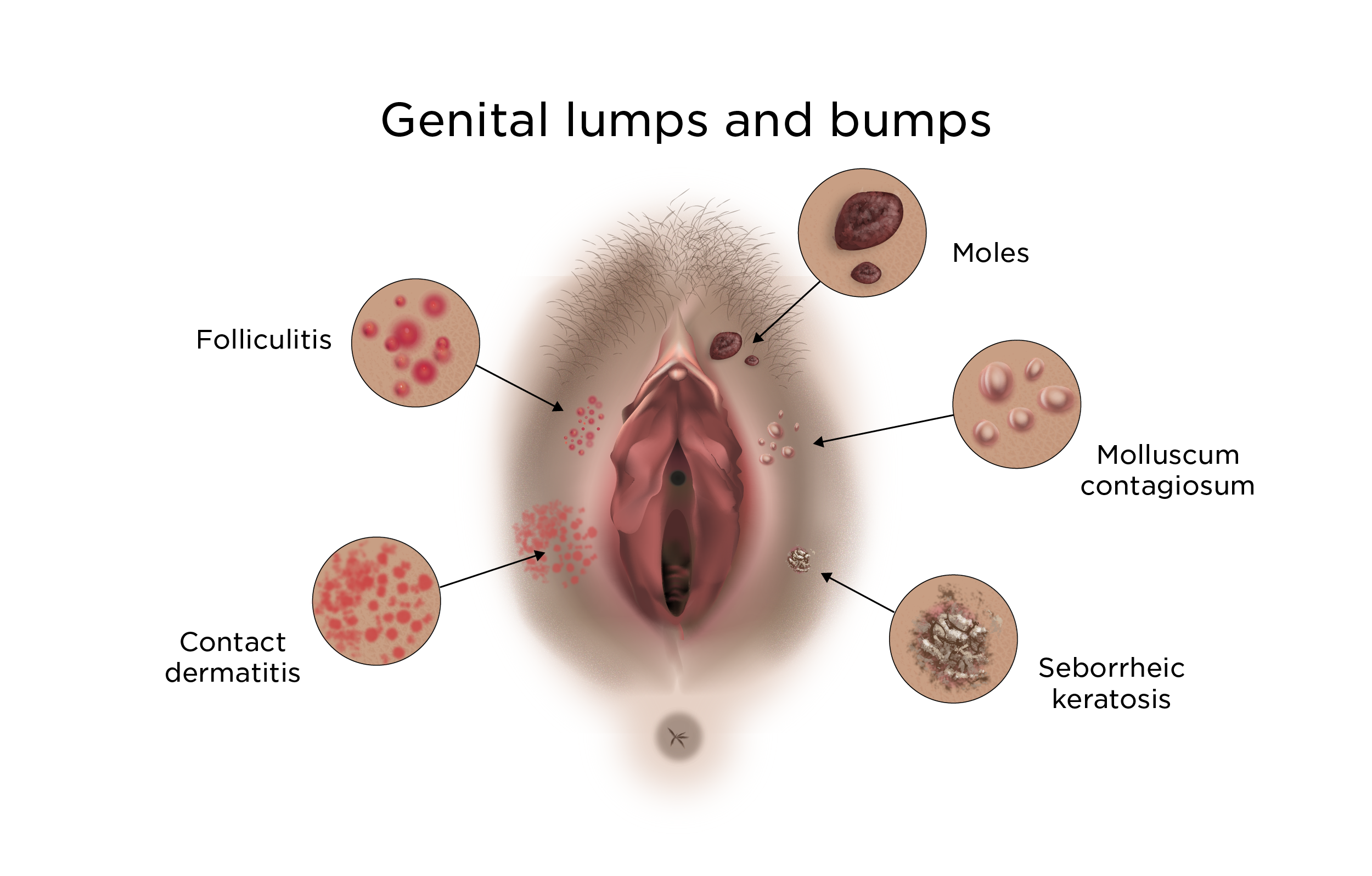 Red Bumps on Your Genitals?